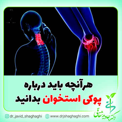 هرآنچه باید درباره پوکی استخوان بدانید