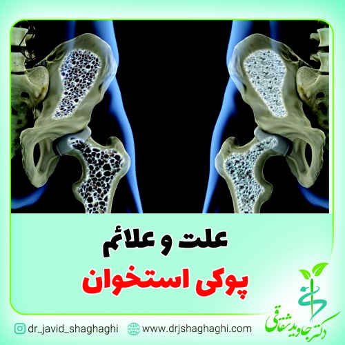 علت و علائم پوکی استخوان