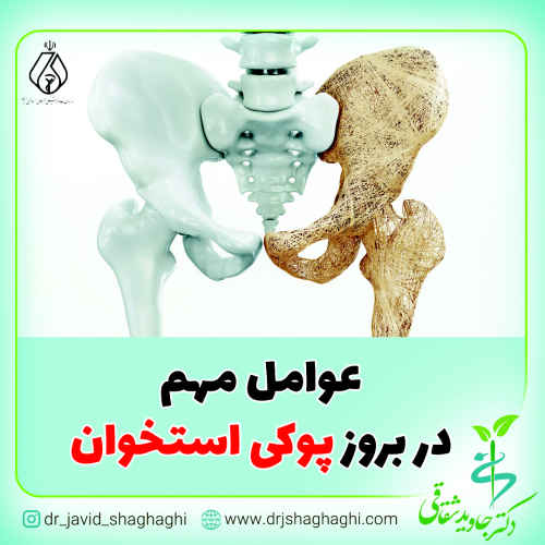 عوامل مهم در بروز پوکی استخوان