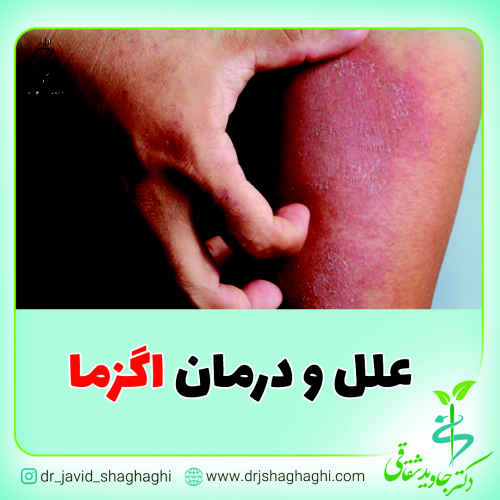 علل و درمان اگزما