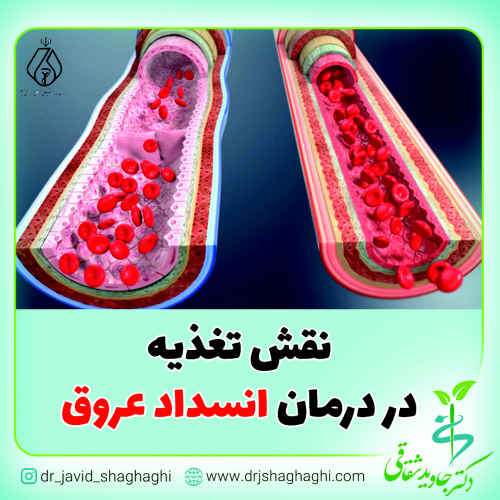 نقش تغذیه در درمان انسداد عروق