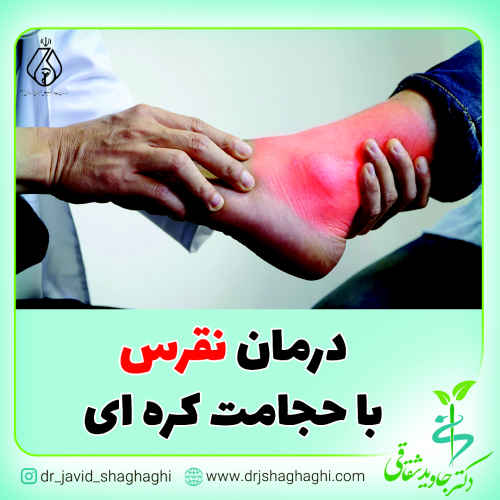 درمان نقرس با حجامت کره ای